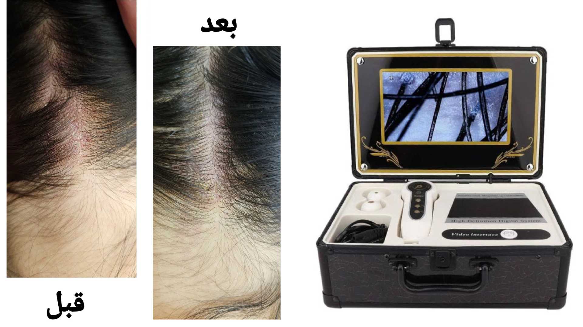 اسکالپ کف سر در بابل | راهحل تخصصی برای زیبایی و پرپشتی مو